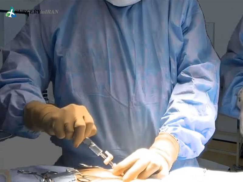 Laparoscopic surgery