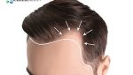 Natural hair transplant method fut