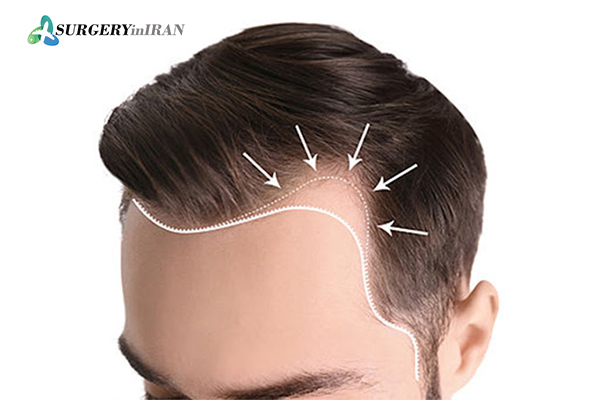 Natural hair transplant method fut